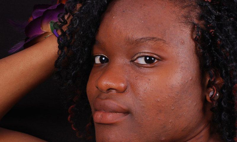 5 natural ways to get rid of acne scars and pimple marks