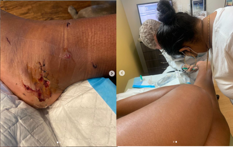 Megan Thee Stallion gunshot wound