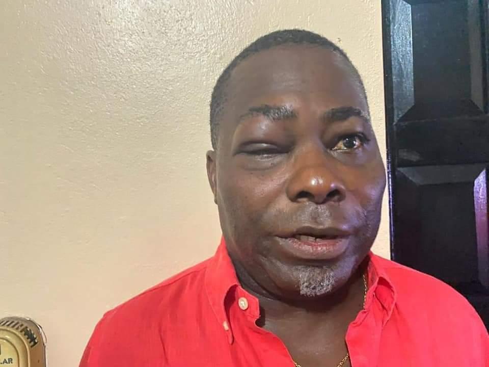 President Staffer Charles Bissue with a bruised face