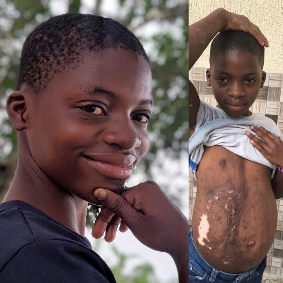 3-year-old girl accused of witchcraft and set ablaze has transformed