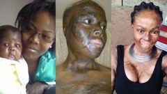 Woman recalls how she lost her daughter after lover set them ablaze