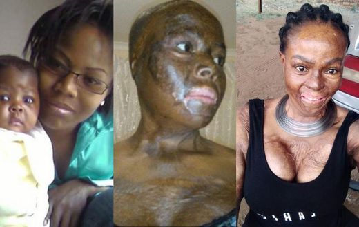 Woman recalls how she lost her daughter after lover set them ablaze