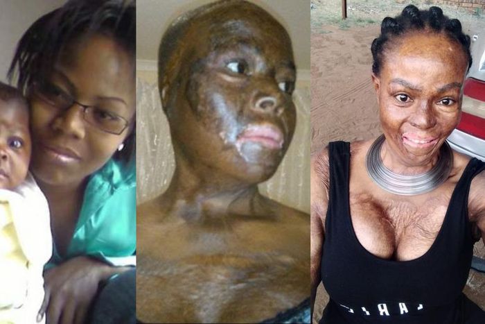 Woman recalls how she lost her daughter after lover set them ablaze