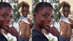 3-year-old girl accused of witchcraft and set ablaze has transformed