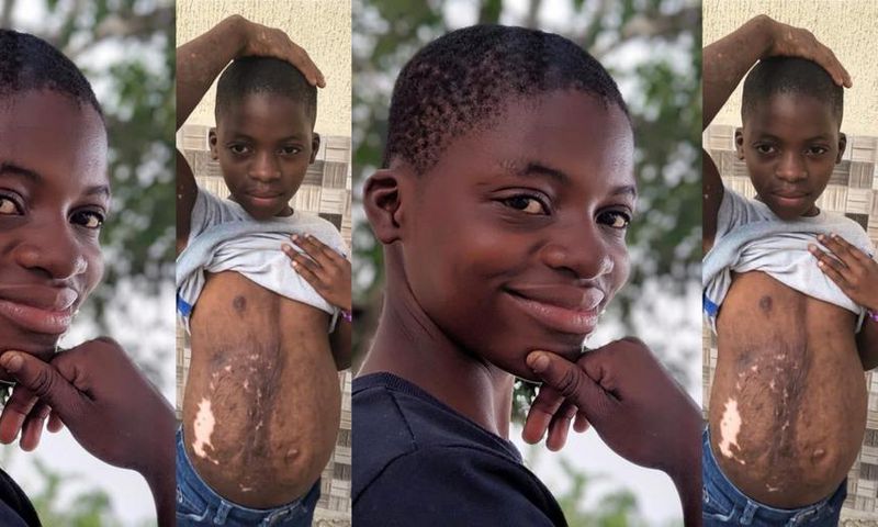 3-year-old girl accused of witchcraft and set ablaze has transformed