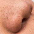 4 simple remedies to get rid of pimples on the nose