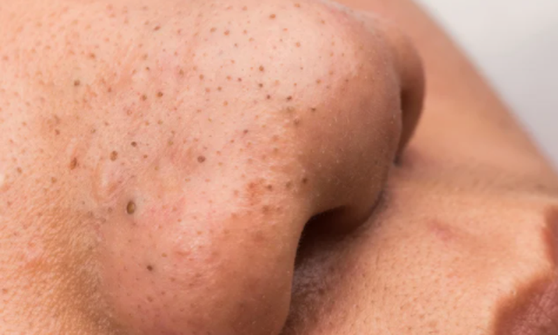 4 simple remedies to get rid of pimples on the nose