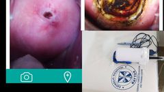 The portable Cure/Liger Medical Electrosurgical Unit. Cervix before and after treatment by LEEP