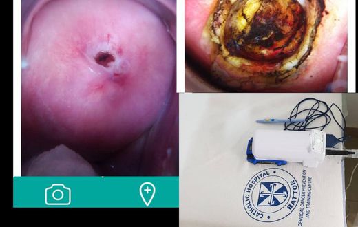 The portable Cure/Liger Medical Electrosurgical Unit. Cervix before and after treatment by LEEP