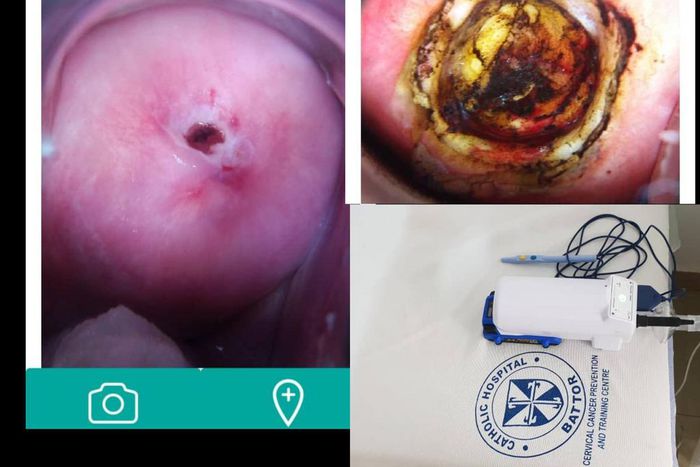 The portable Cure/Liger Medical Electrosurgical Unit. Cervix before and after treatment by LEEP