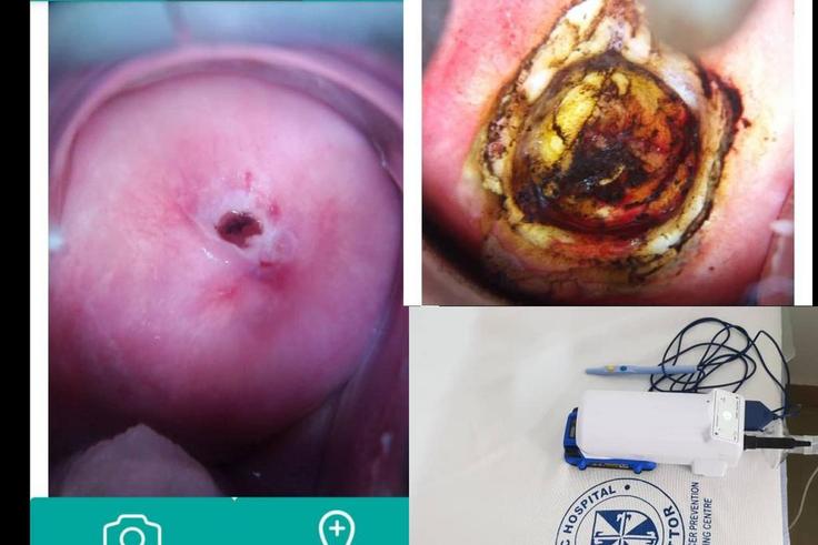 The portable Cure/Liger Medical Electrosurgical Unit. Cervix before and after treatment by LEEP