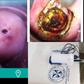 The portable Cure/Liger Medical Electrosurgical Unit. Cervix before and after treatment by LEEP
