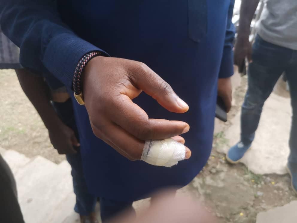 Tarkwa-Nsuem MP, George Mireku Duker, with bandage on his bitten finger
