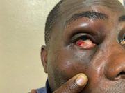Charles Bissue with a bloodied eye