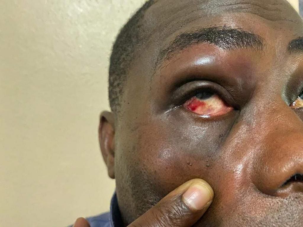 Charles Bissue with a bloodied eye