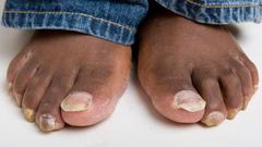 4 home remedies to treating toenail fungus