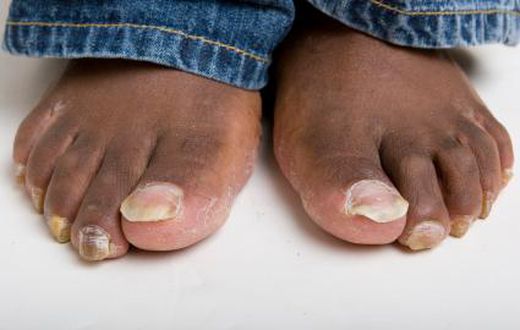 4 home remedies to treating toenail fungus