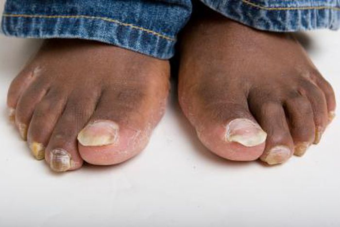 4 home remedies to treating toenail fungus