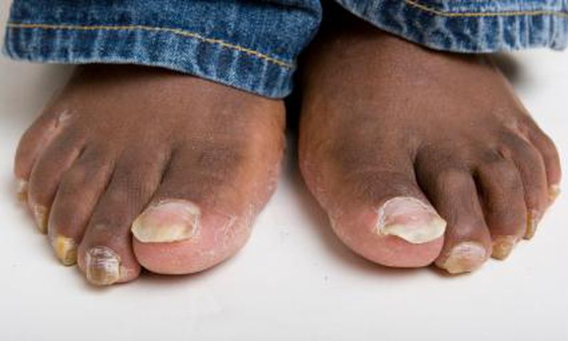 4 home remedies to treating toenail fungus