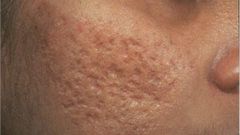 4 natural remedies to getting rid of open pores