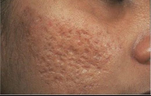 4 natural remedies to getting rid of open pores