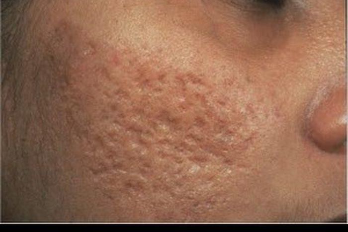 4 natural remedies to getting rid of open pores