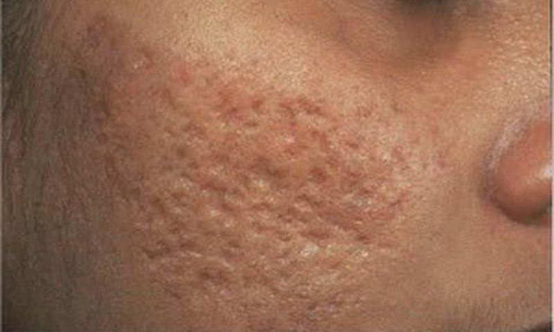 4 natural remedies to getting rid of open pores