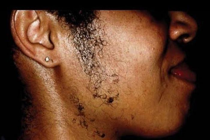 Facial hair home remedies