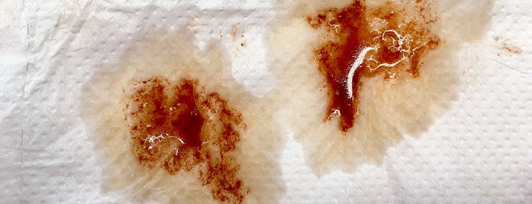 brown-vaginal-discharge