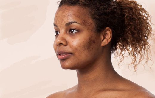 How to treat acne with sea salt