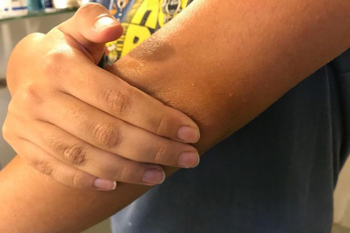 Here's how to get rid of dark elbows naturally. [sandandorsnow]