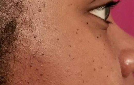 Skin tags