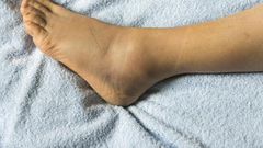 Swollen foot