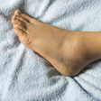 Swollen foot