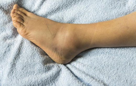 Swollen foot