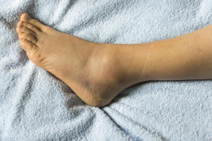 Swollen foot