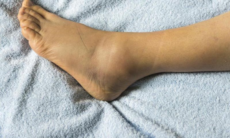Swollen foot