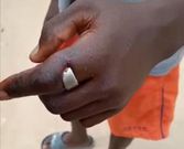 Kasoa boy likely to lose finger after wearing friend's skawa ring; pastors & doctors can’t help