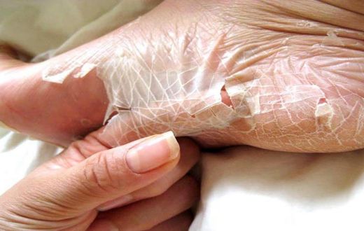 Peeling skin