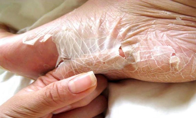Peeling skin