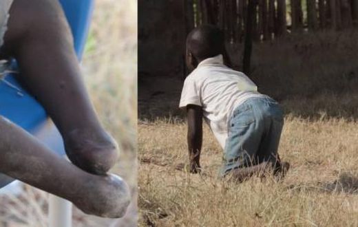 Mother calls for help to enable son who has lost his feet to walk again