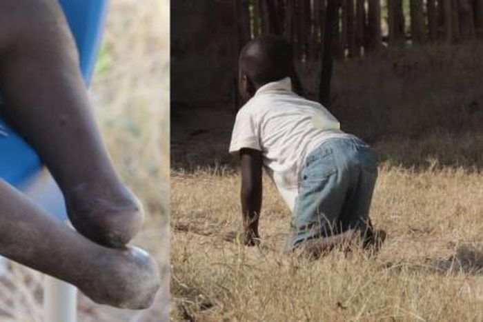 Mother calls for help to enable son who has lost his feet to walk again