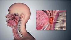 Oral sex becomes the leading cause of throat cancer
