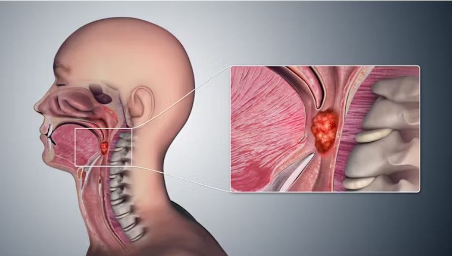 Oral sex becomes the leading cause of throat cancer