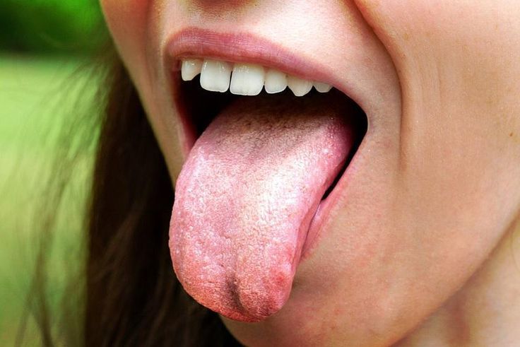 4 symptoms of candida overgrowth and how to treat it