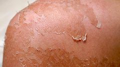 Peeling skin