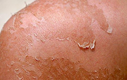 Peeling skin