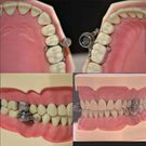 Weight loss device that locks your teeth to stop you from chewing until you become slim