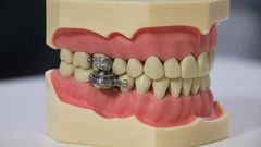 Weight loss device that locks your teeth to stop you from chewing until you become slim