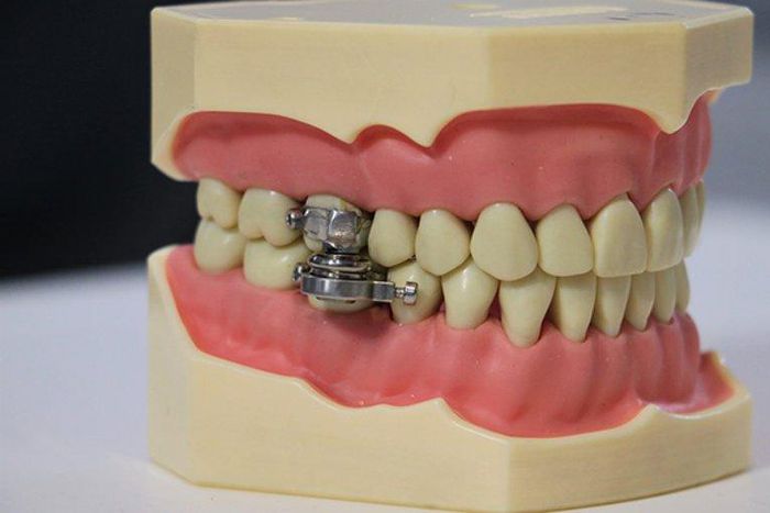 Weight loss device that locks your teeth to stop you from chewing until you become slim